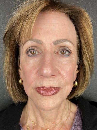 Renuvion Resurfacing Before & After Gallery - Patient 120023 - Image 2