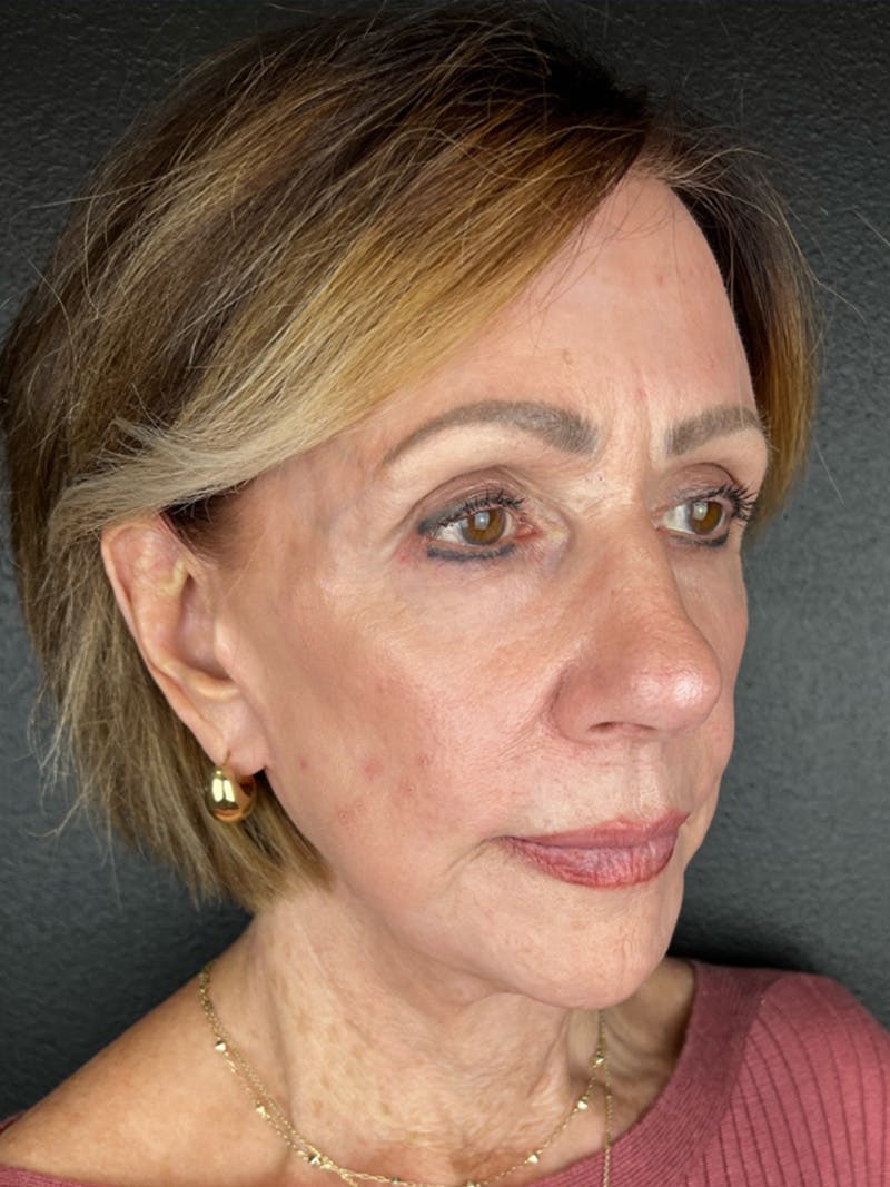 Renuvion Resurfacing Before & After Gallery - Patient 120023 - Image 4