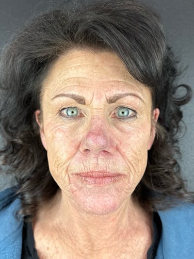 Renuvion Resurfacing Before & After Gallery - Patient 251963 - Image 1