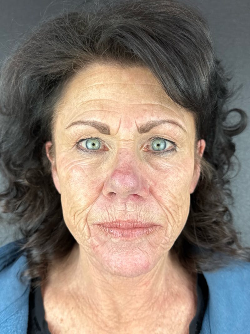 Renuvion Resurfacing Before & After Gallery - Patient 251963 - Image 1