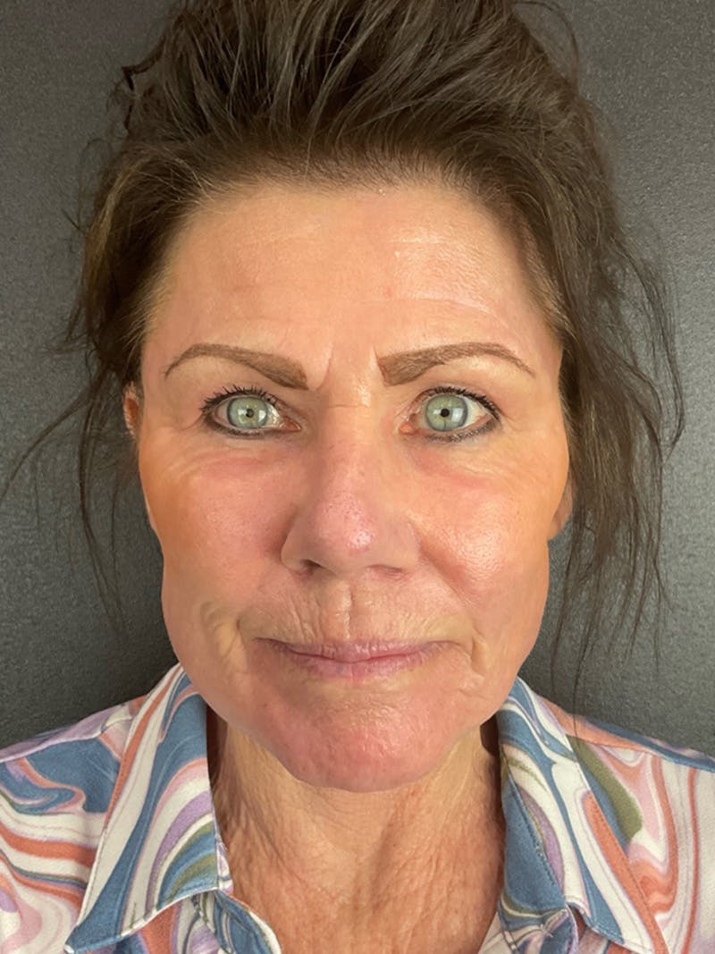 Renuvion Resurfacing Before & After Gallery - Patient 251963 - Image 2