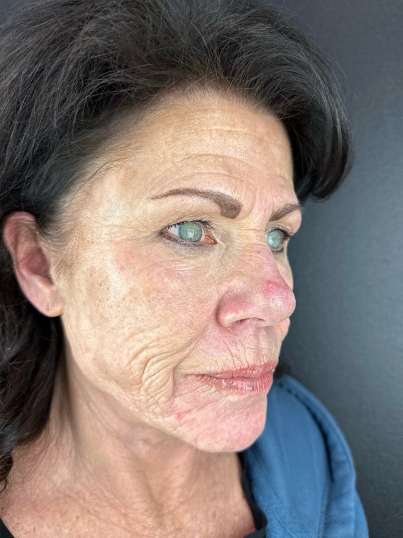 Renuvion Resurfacing Before & After Gallery - Patient 251963 - Image 3