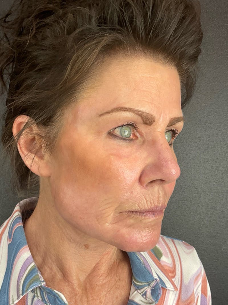 Renuvion Resurfacing Before & After Gallery - Patient 251963 - Image 4