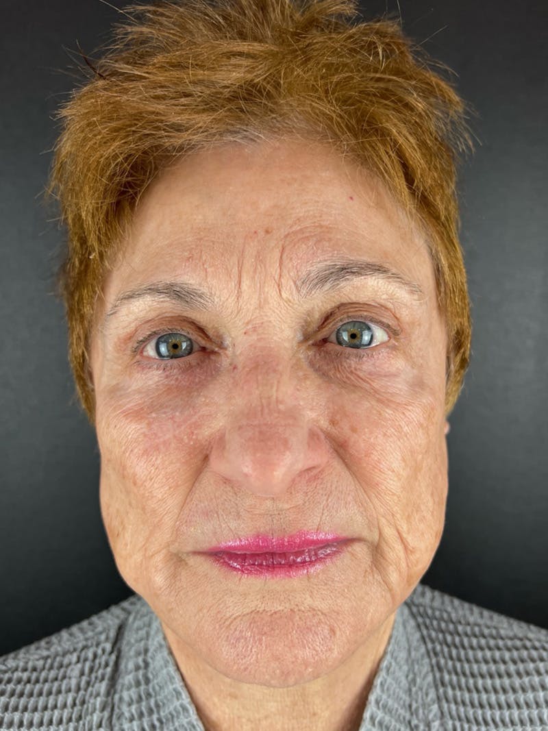 Renuvion Resurfacing Before & After Gallery - Patient 300963 - Image 1