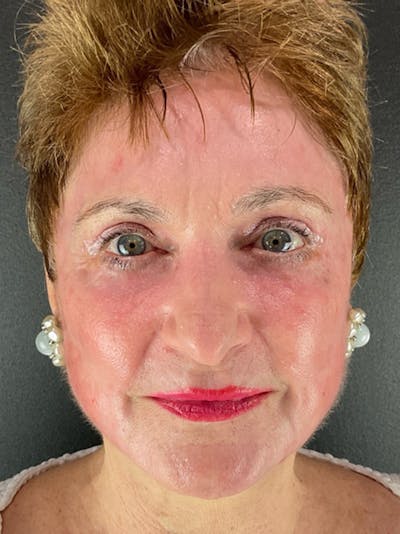 Renuvion Resurfacing Before & After Gallery - Patient 300963 - Image 2
