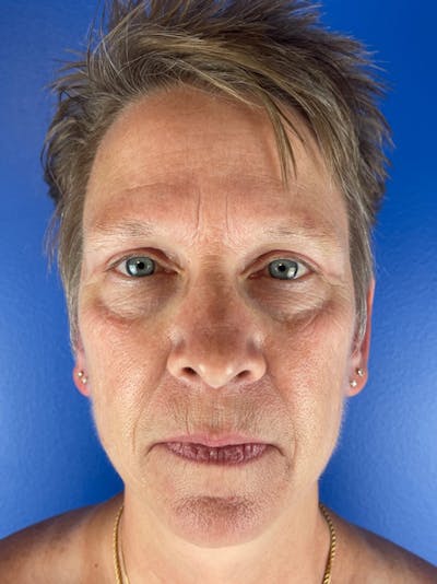 Renuvion Resurfacing Before & After Gallery - Patient 234902 - Image 1