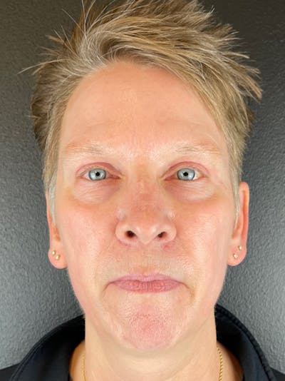 Renuvion Resurfacing Before & After Gallery - Patient 234902 - Image 2