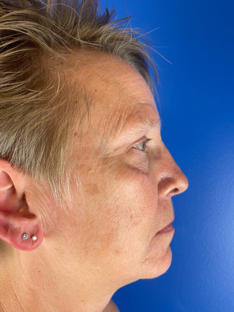 Renuvion Resurfacing Before & After Gallery - Patient 234902 - Image 3