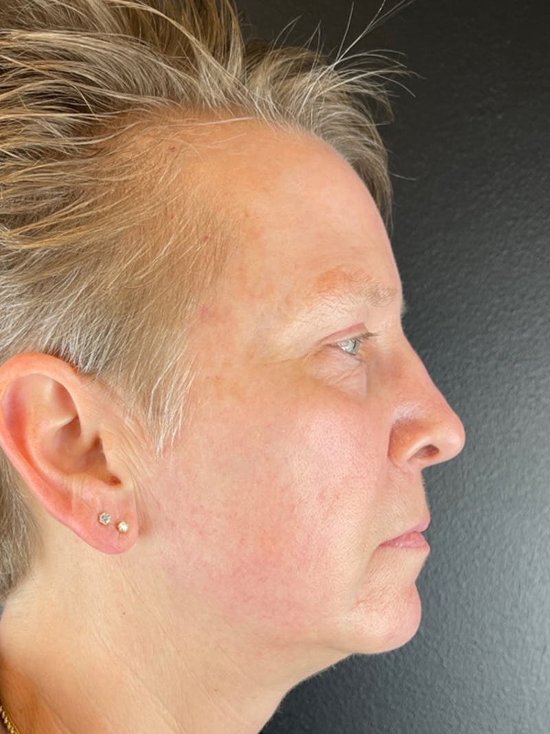 Renuvion Resurfacing Before & After Gallery - Patient 234902 - Image 4
