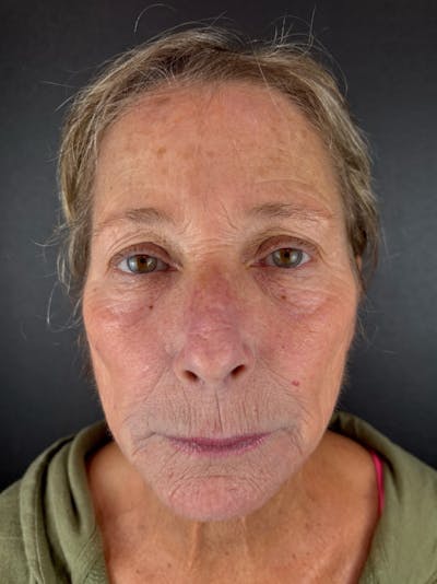 Renuvion Resurfacing Before & After Gallery - Patient 337354 - Image 1