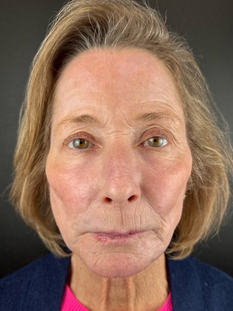 Renuvion Resurfacing Before & After Gallery - Patient 337354 - Image 2