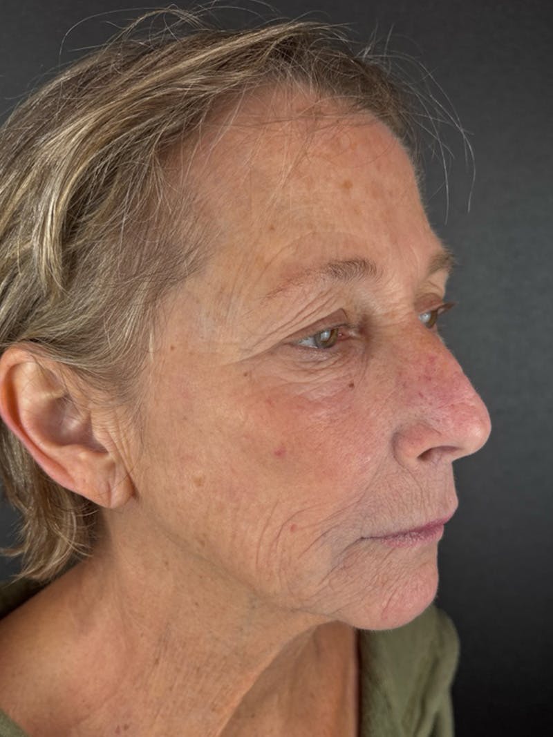 Renuvion Resurfacing Before & After Gallery - Patient 337354 - Image 3