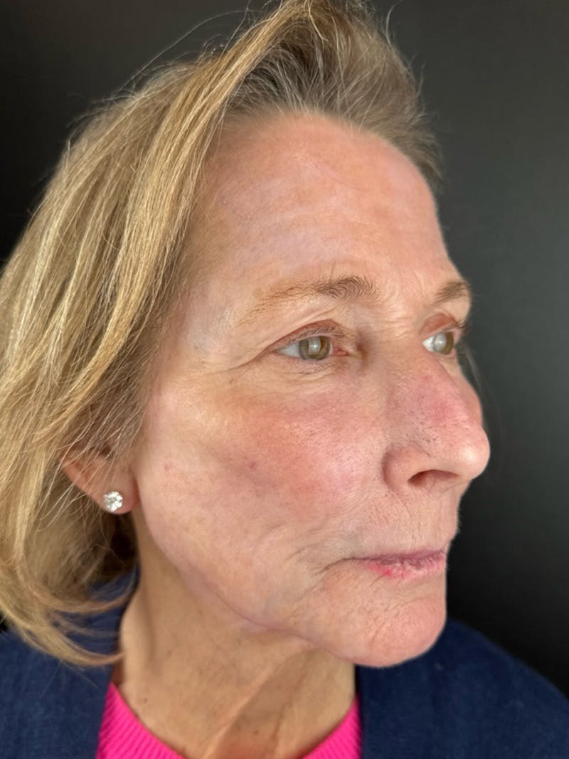 Renuvion Resurfacing Before & After Gallery - Patient 337354 - Image 4