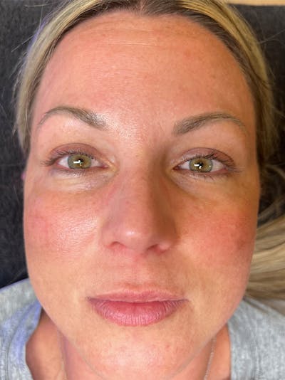 Lash Lift Before & After Gallery - Patient 517985 - Image 1