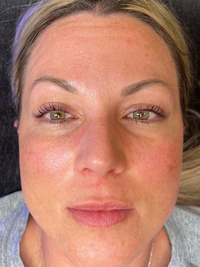 Lash Lift Before & After Gallery - Patient 517985 - Image 2