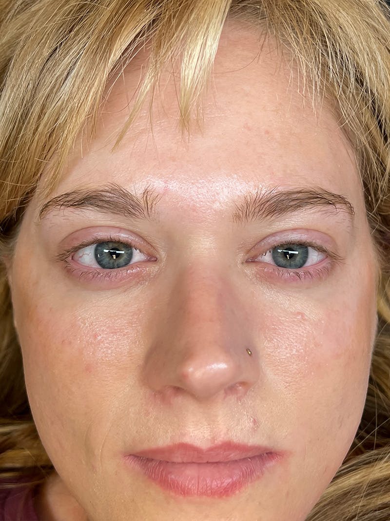 Lash Lift Before & After Gallery - Patient 389203 - Image 1