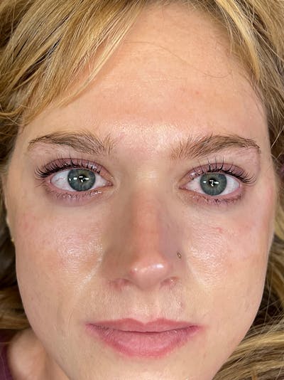 Lash Lift Before & After Gallery - Patient 389203 - Image 2