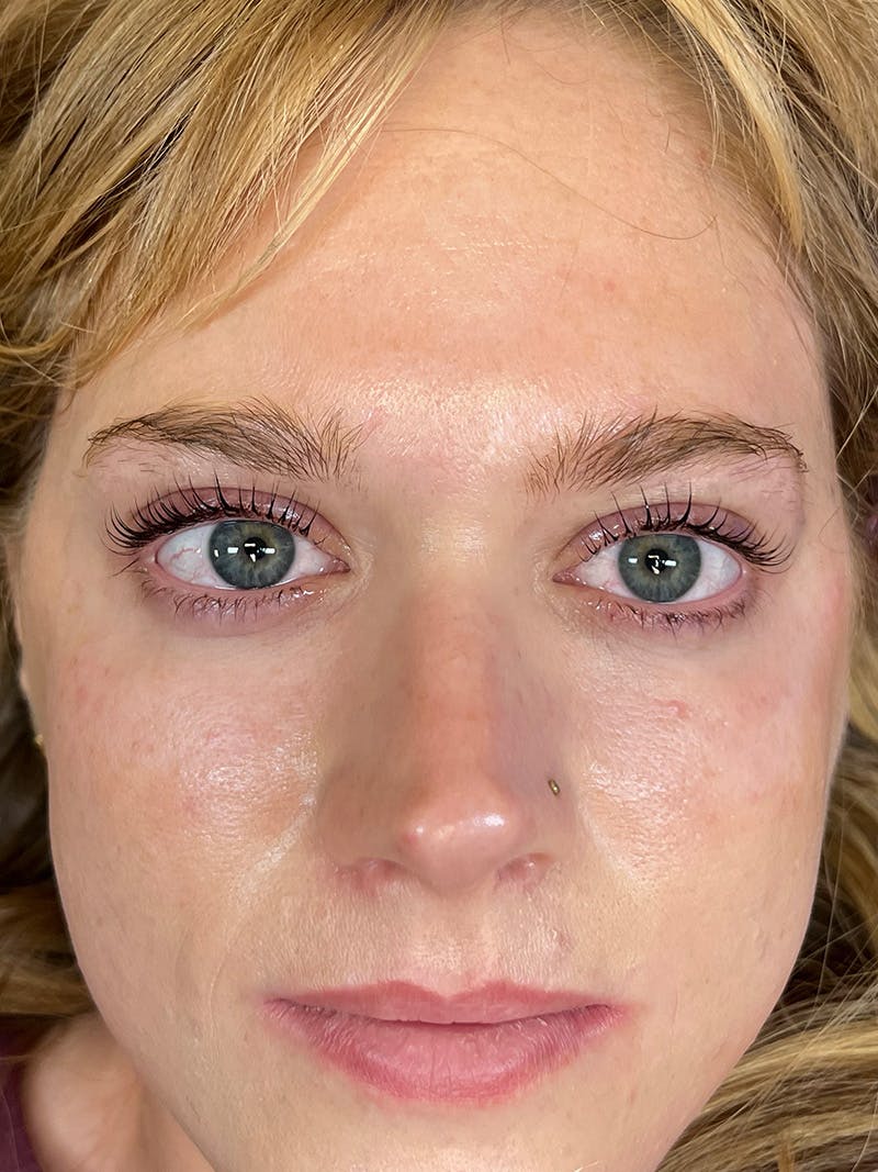 Lash Lift Before & After Gallery - Patient 389203 - Image 2