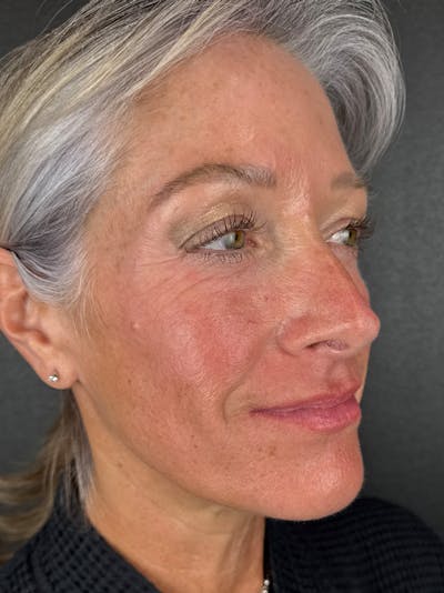 Radiesse Before & After Gallery - Patient 253042 - Image 1