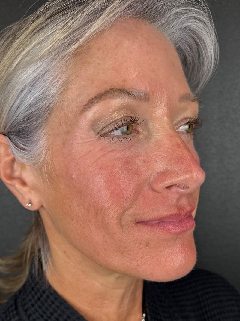 Radiesse Before & After Gallery - Patient 253042 - Image 1