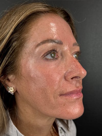 Radiesse Before & After Gallery - Patient 253042 - Image 2