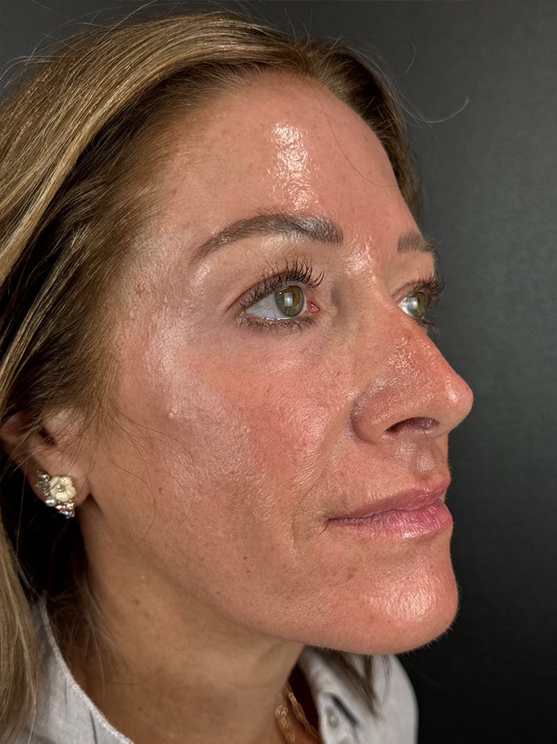 Radiesse Before & After Gallery - Patient 253042 - Image 2