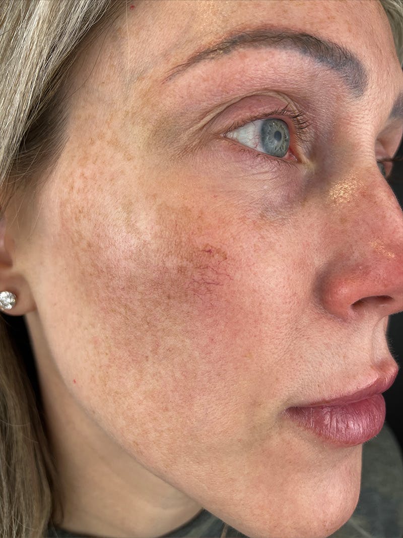 IPL Before & After Gallery - Patient 924703 - Image 1