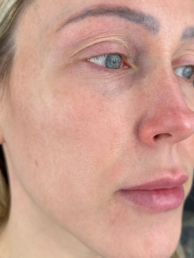 IPL Before & After Gallery - Patient 924703 - Image 2