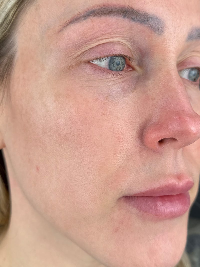 IPL Before & After Gallery - Patient 924703 - Image 2