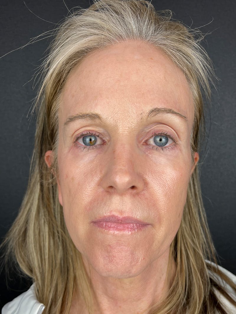 Sculptra Before & After Gallery - Patient 197332 - Image 1
