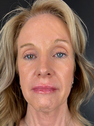 Sculptra Before & After Gallery - Patient 197332 - Image 2