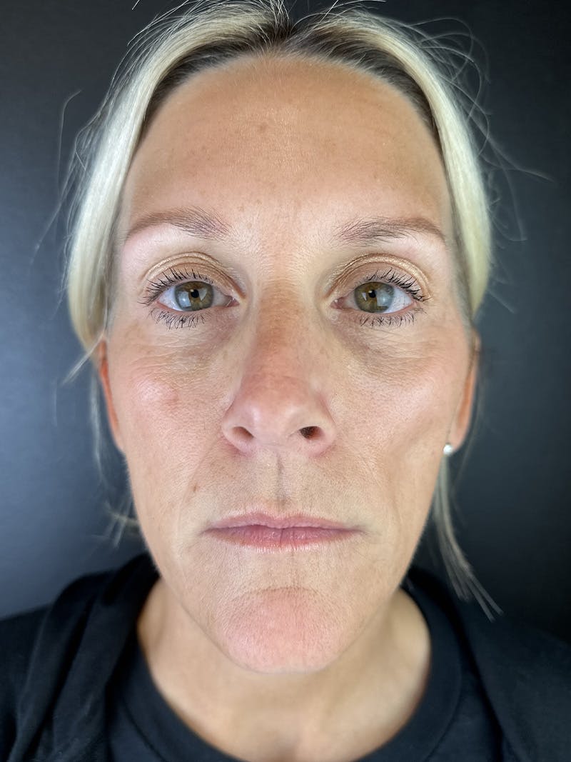 Sculptra Before & After Gallery - Patient 330106 - Image 1