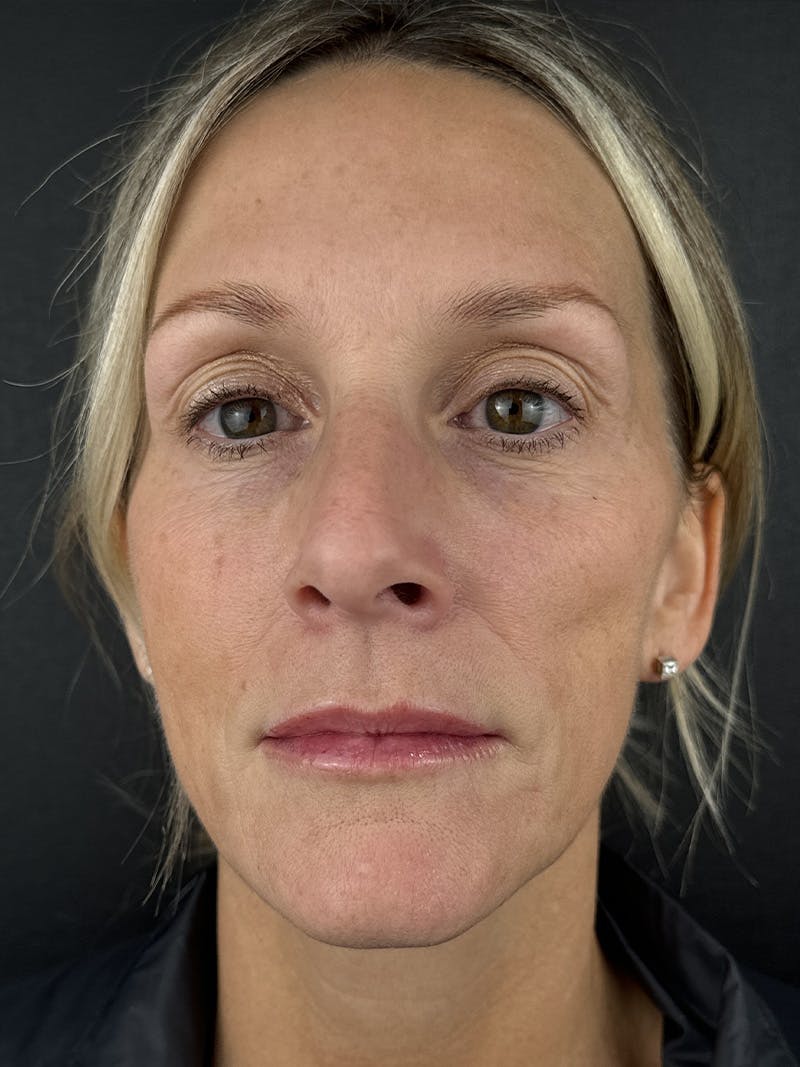 Sculptra Before & After Gallery - Patient 330106 - Image 2