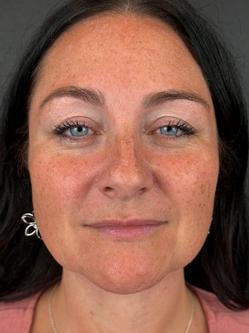 Lower Face Filler Before & After Gallery - Patient 110852 - Image 1