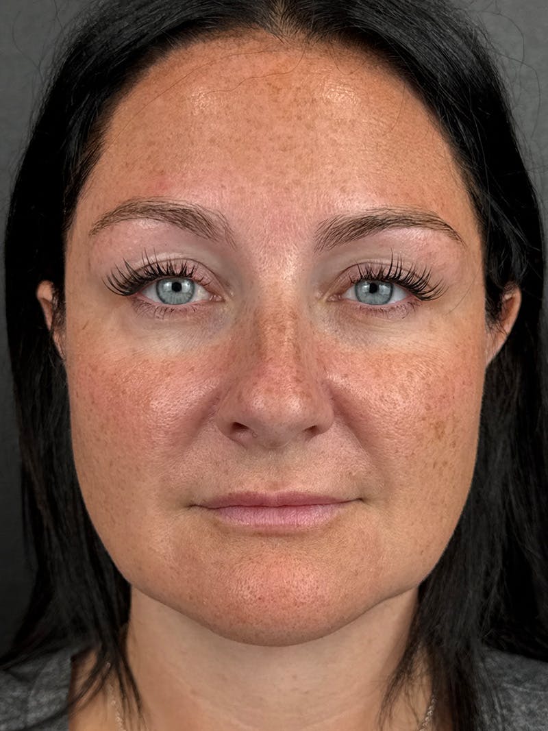 Lower Face Filler Before & After Gallery - Patient 110852 - Image 2