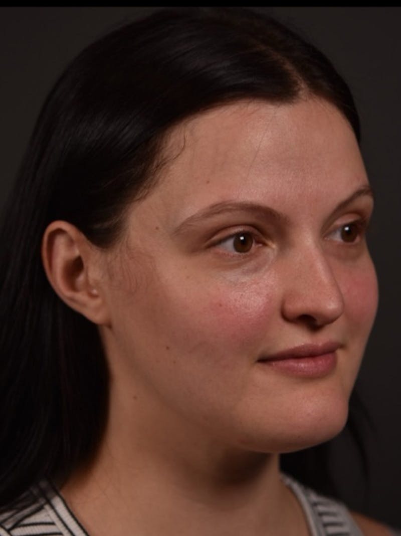 Cheek Filler Before & After Gallery - Patient 170834 - Image 1
