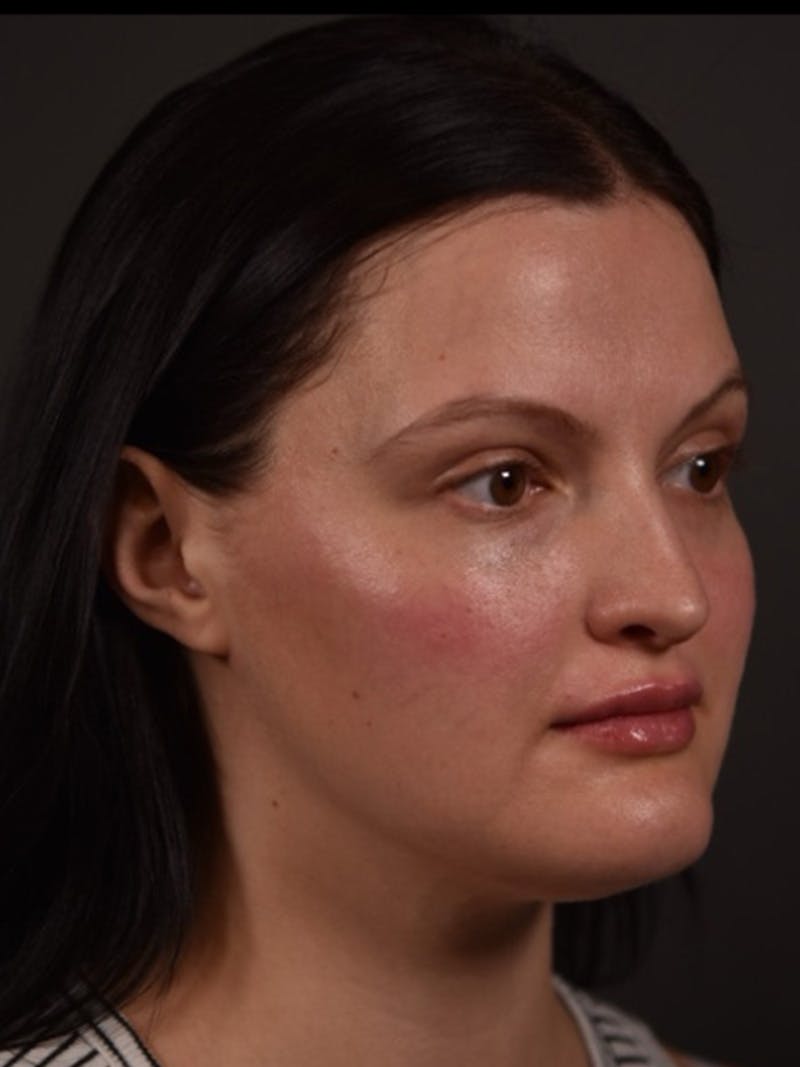 Cheek Filler Before & After Gallery - Patient 170834 - Image 2
