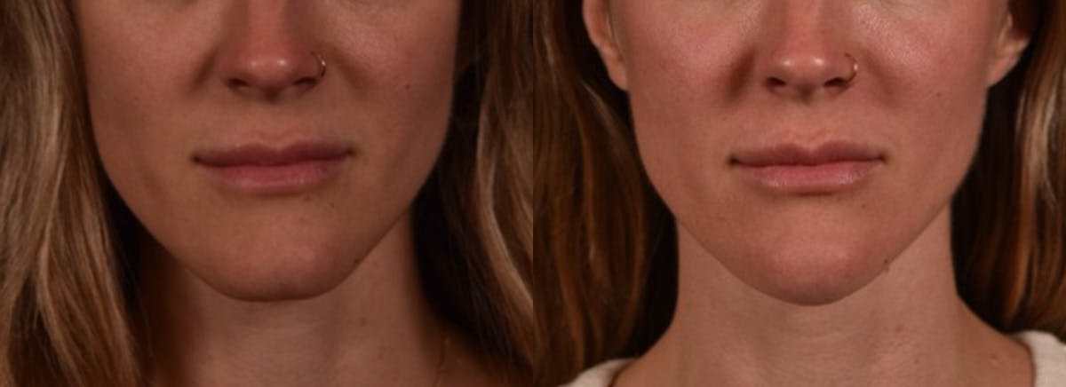 Chin Filler Before & After Gallery - Patient 754866 - Image 1