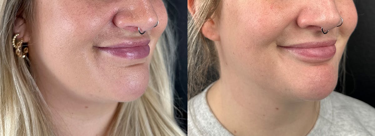 Chin Filler Before & After Gallery - Patient 149143 - Image 1