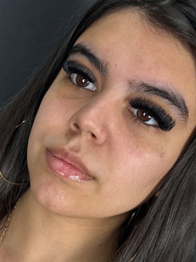 Lip Filler Before & After Gallery - Patient 180555 - Image 1