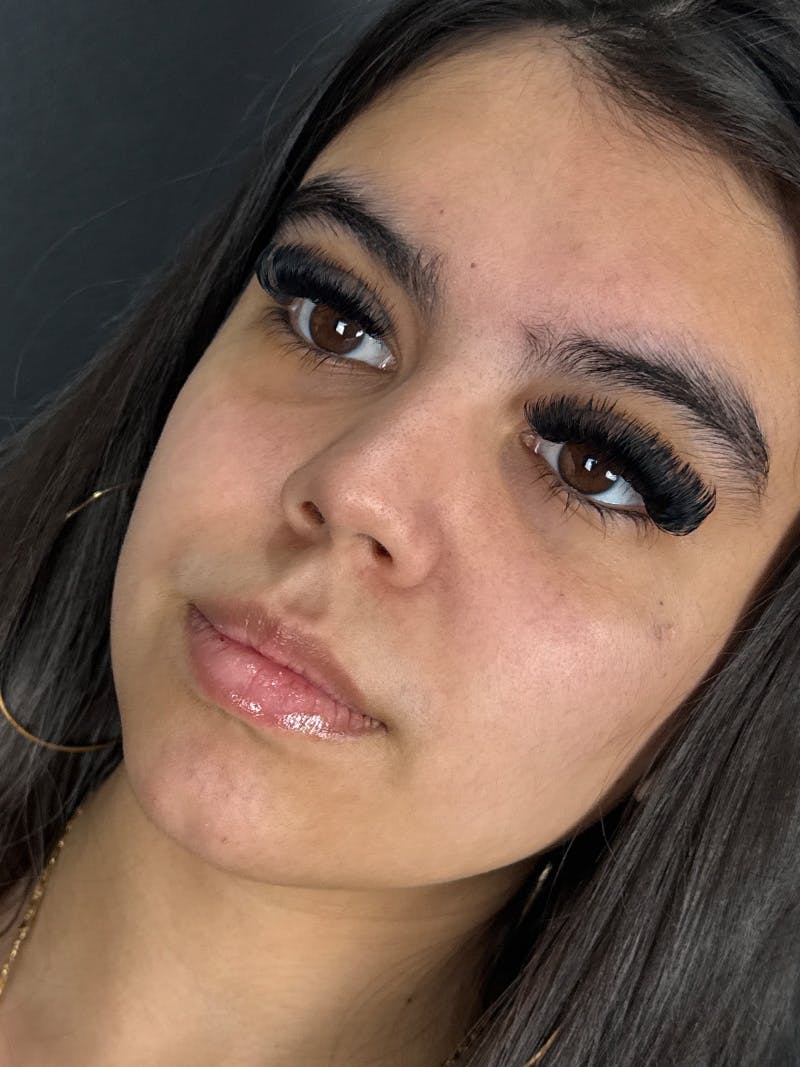 Lip Filler Before & After Gallery - Patient 180555 - Image 1