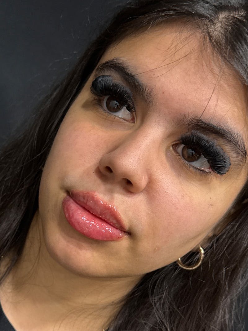 Lip Filler Before & After Gallery - Patient 180555 - Image 2
