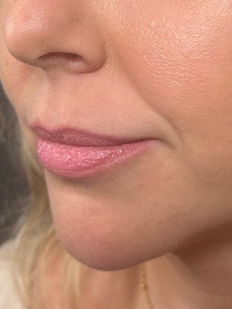 Lip Filler Before & After Gallery - Patient 344448 - Image 1