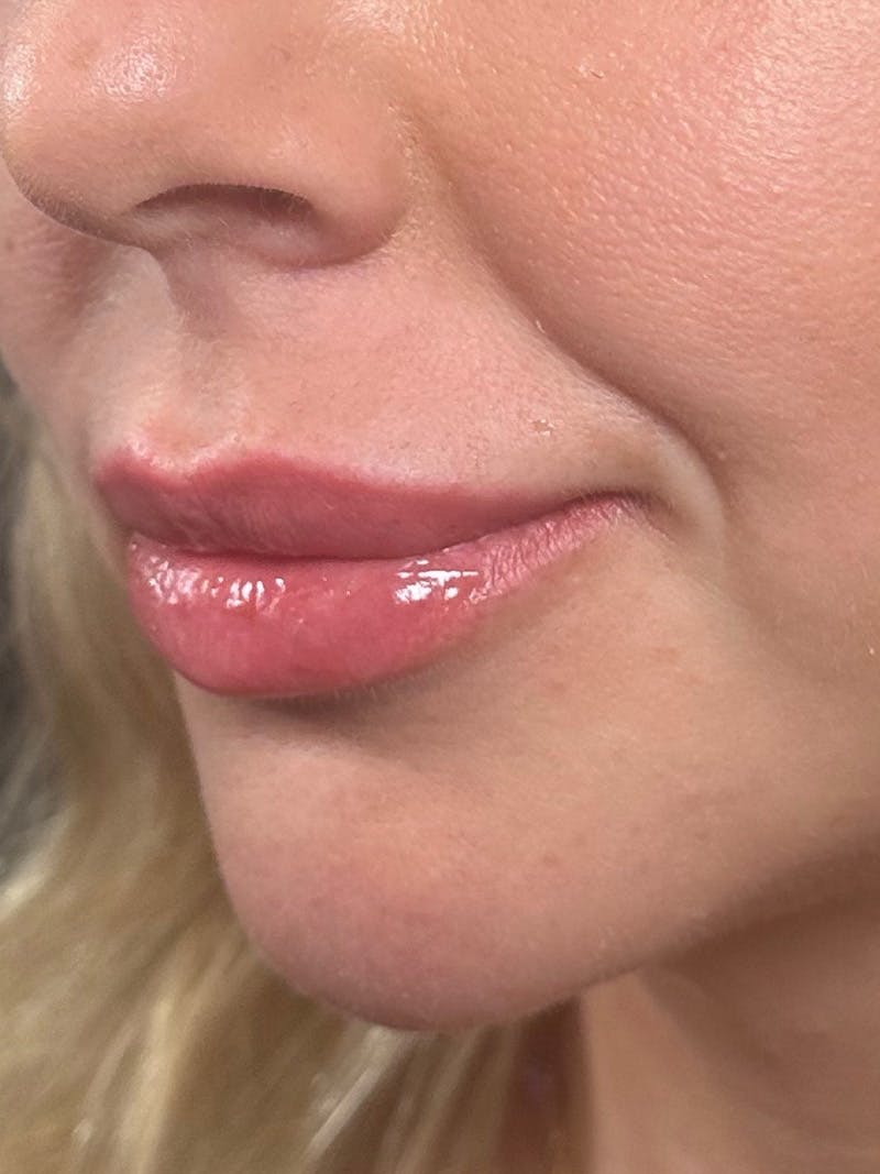 Lip Filler Before & After Gallery - Patient 344448 - Image 2