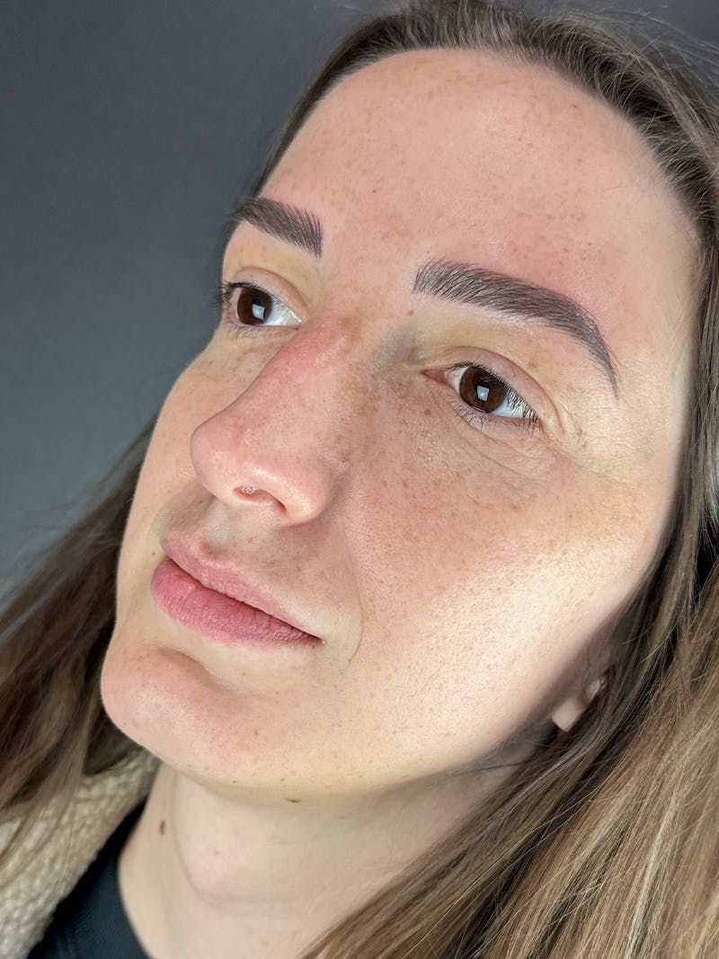 Lip Filler Before & After Gallery - Patient 166717 - Image 1
