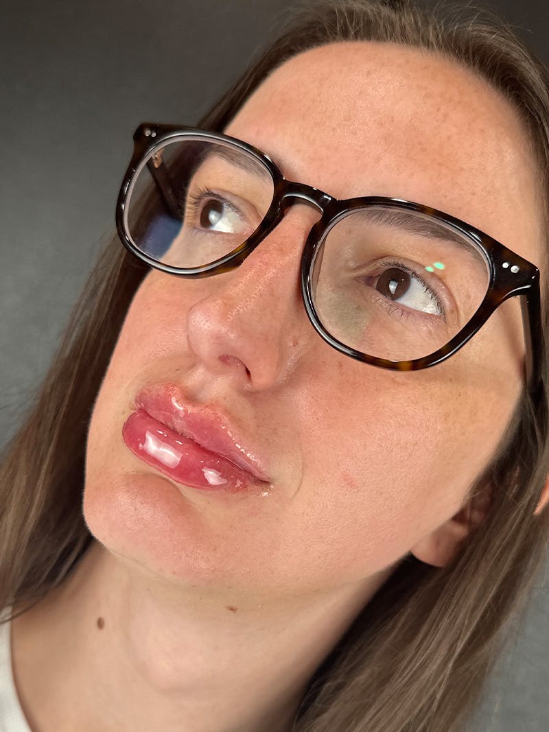 Lip Filler Before & After Gallery - Patient 166717 - Image 2