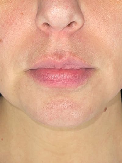 Lip Filler Before & After Gallery - Patient 345064 - Image 1
