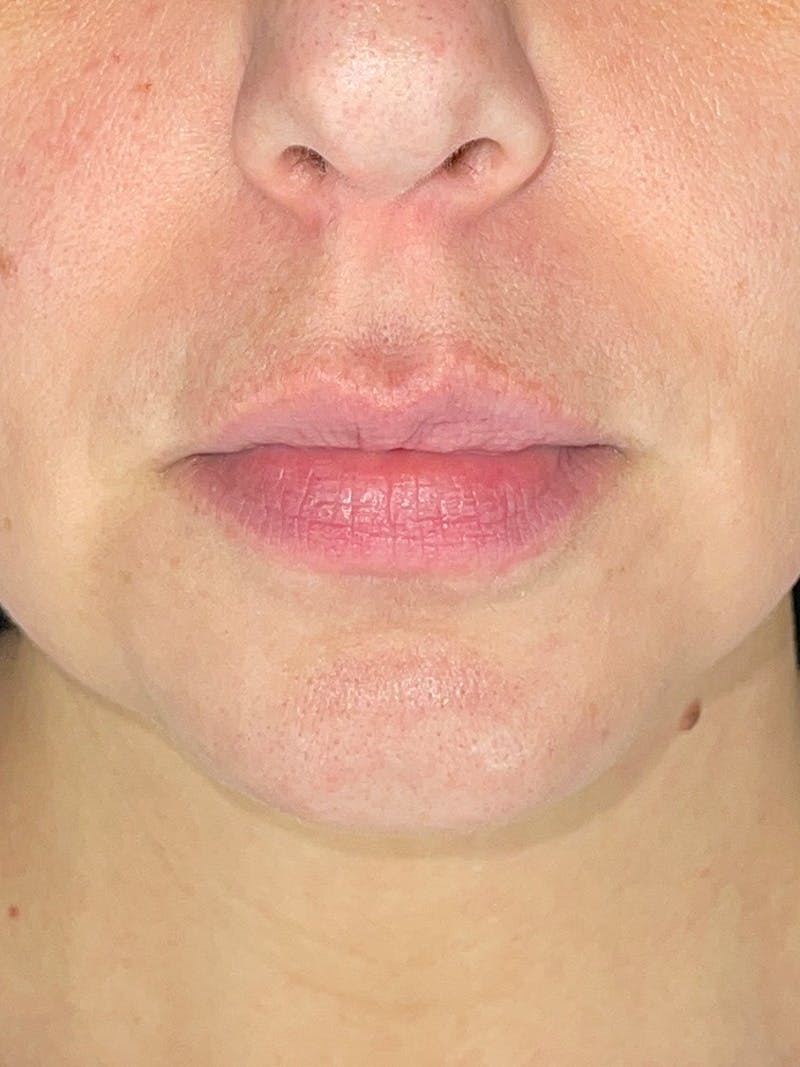 Lip Filler Before & After Gallery - Patient 345064 - Image 1