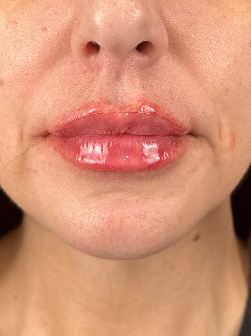 Lip Filler Before & After Gallery - Patient 345064 - Image 2