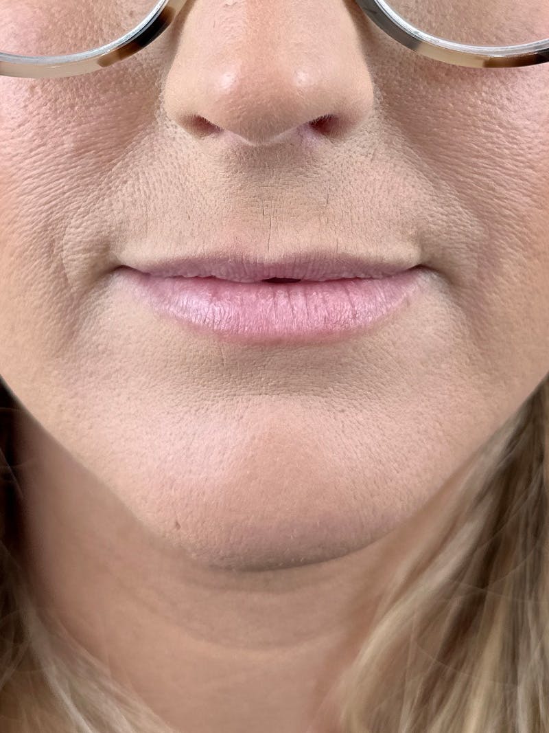 Lip Filler Before & After Gallery - Patient 384971 - Image 1